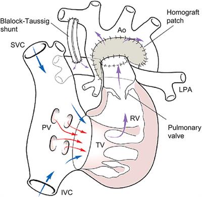 Mechanical Circulatory Support for Single Ventricle Failure